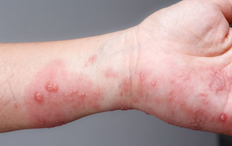 shingles rash